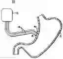 Fig. 01 - Gastric stimulator apparatus and method for use
