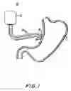 Fig. 02 - Gastric stimulator apparatus and method for use