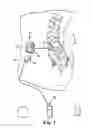 Fig. 02 - Implantable medical device and electrical stimulation device with magnetic shield