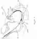 Fig. 05 - Implantable lead including sensor
