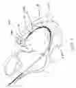 Fig. 06 - Implantable lead including sensor
