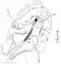 Fig. 09 - Implantable lead including sensor