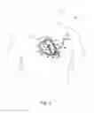 Fig. 02 - Myocardial lead attachment system