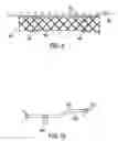 Fig. 06 - Composite stent with inner and outer stent elements and method of using the same