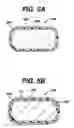 Fig. 07 - Method and apparatus for treating vulnerable coronary plaques using drug-eluting stents