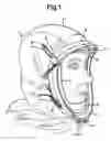 Fig. 02 - Respirator assembly