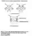 Fig. 31 - Turbine generator vibration damper system