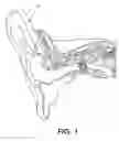 Fig. 02 - In the ear hearing aid utilizing annular ring acoustic seals