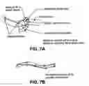 Fig. 08 - Automated centerline detection algorithm for colon-like 3D surfaces