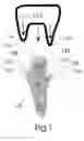 Fig. 02 - Gingival retraction device and method