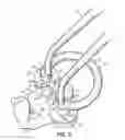 Fig. 05 - DEVICE AND SYSTEM FOR SEPARATION AND MATRIX RETENTION AND ADAPTATION DURING DENTAL RESTORATION AND METHOD FOR PREPARING TOOTH USING SYSTEM