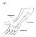 Fig. 02 - Methods for minimizing spasticity in blood vessel grafts