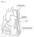 Fig. 03 - Methods for minimizing spasticity in blood vessel grafts