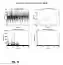 Fig. 11 - Continuous volume detection for a flexible venous reservoir in a cardiopulmonary bypass circuit
