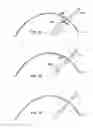Fig. 23 - Devices and methods for performing procedures on a breast