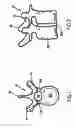Fig. 02 - Polyaxial pedicle screw having a rotating locking element