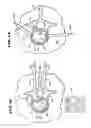 Fig. 12 - Systems and methods for treating fractured or diseased bone using expandable bodies