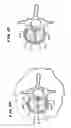 Fig. 13 - Systems and methods for treating fractured or diseased bone using expandable bodies