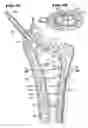 Fig. 18 - Systems and methods for treating fractured or diseased bone using expandable bodies