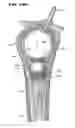 Fig. 19 - Systems and methods for treating fractured or diseased bone using expandable bodies