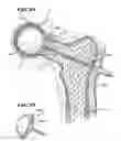 Fig. 23 - Systems and methods for treating fractured or diseased bone using expandable bodies