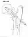 Fig. 24 - Systems and methods for treating fractured or diseased bone using expandable bodies
