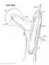Fig. 25 - Systems and methods for treating fractured or diseased bone using expandable bodies