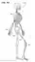 Fig. 30 - Systems and methods for treating fractured or diseased bone using expandable bodies