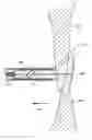 Fig. 01 - Patent foramen ovale closure system