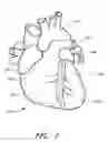 Fig. 02 - Patent foramen ovale closure system