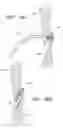 Fig. 31 - Patent foramen ovale closure system