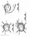 Fig. 08 - Subcutaneous cardiac rhythm management