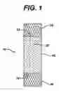 Fig. 02 - Prosthesis graft with Z pleating
