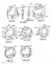 Fig. 04 - Intraocular lenses with fixated haptics