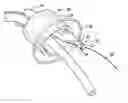 Fig. 01 - Mouthguard having device securing tab