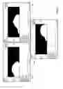 Fig. 04 - Cervical-thoracic-lumbar spine phased array coil for Magnetic Resonance Imaging