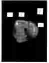 Fig. 03 - Composition and method for prevention and treatment of dental caries