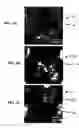 Fig. 07 - Composition and method for prevention and treatment of dental caries