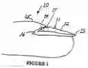 Fig. 02 - Composition and method for treating onychomycosis