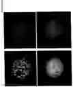 Fig. 15 - Compositions and methods for treating cells having double minute DNA