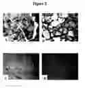 Fig. 04 - Anemia
