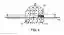 Fig. 04 - Combination ionizing radiation and radiosensitizer delivery devices and methods for inhibiting hyperplasia