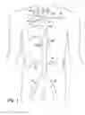 Fig. 02 - Partial aortic occlusion devices and methods for cerebral perfusion augmentation