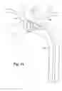 Fig. 32 - Partial aortic occlusion devices and methods for cerebral perfusion augmentation