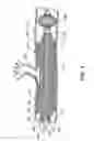 Fig. 08 - Particle-removing medical device and method