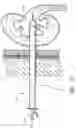 Fig. 10 - Expandable percutaneous sheath