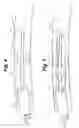 Fig. 03 - Method of removing debris corresponding with the R-wave