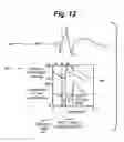 Fig. 07 - Method of removing debris corresponding with the R-wave