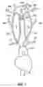 Fig. 02 - Apparatus and methods for treating stroke and controlling cerebral flow characteristics