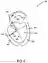 Fig. 10 - Flexible polymer needle catheter
